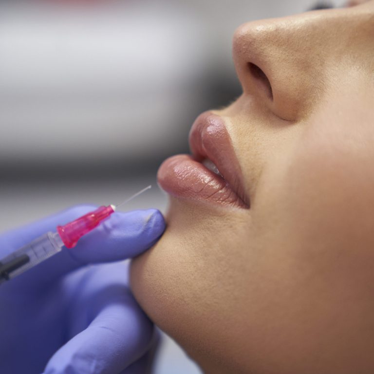 Dermal Fillers Lip Fillers Buckshaw Village Chorley
