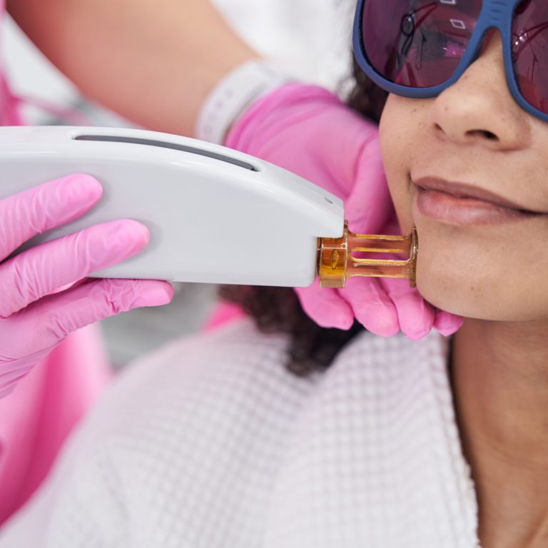 Laser treatments Buckshaw Village Chorley